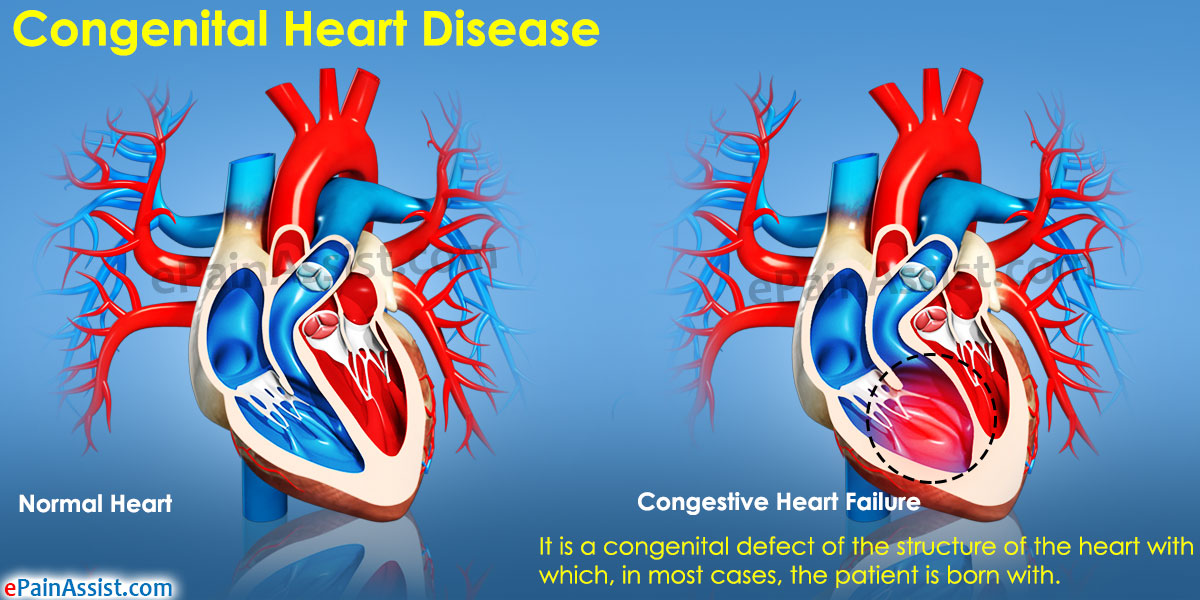 Types Of Congenital Heart Abnormalities