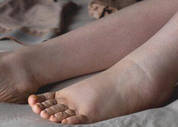 Living with Lymphoedema: two Kilkenny ladies bid to create more awareness of the long-term chronic condition